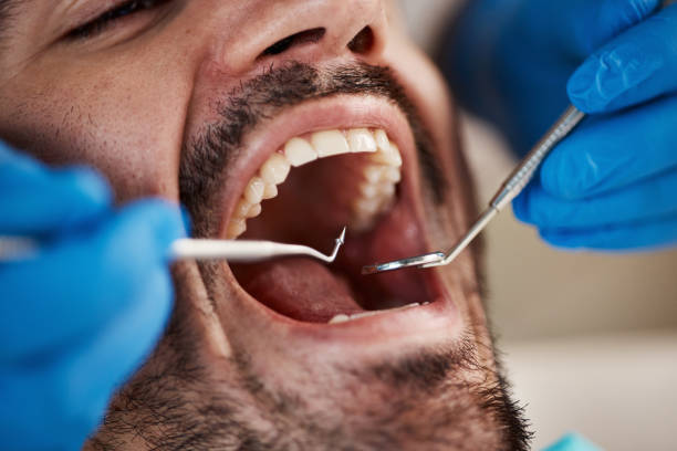 Best Wisdom Tooth Removal  in Sunflower, MS